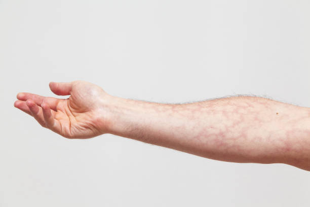 forearm with red skin capillary network stock photo