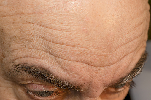 The forehead of a bald aging man with pronounced wrinkles