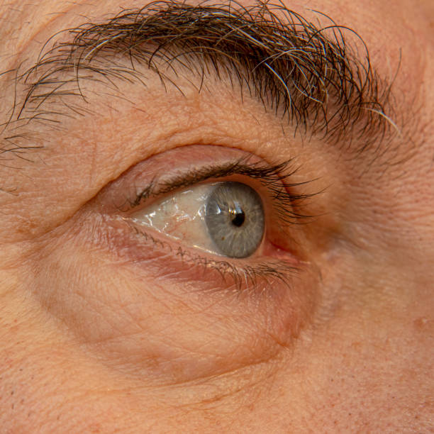 istock Tired reddened eye of an aging man with wrinkles. 1293532001