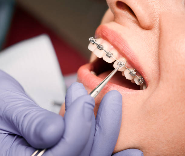 ortodontist kadın hasta parantez üzerine lastik bantlar yerleştirerek. - diş telleri stok fotoğraflar ve resimler