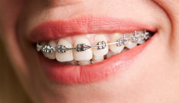 istock Female smile with metal braces on white teeth. 1293534229