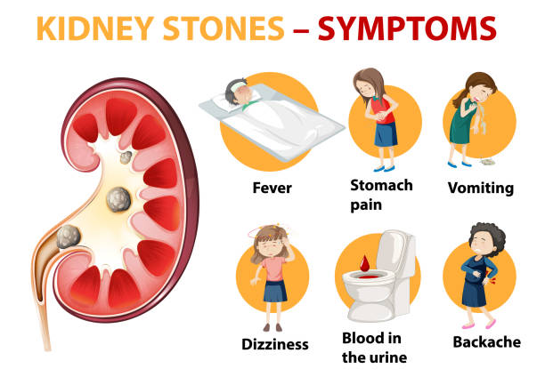 illustrazioni stock, clip art, cartoni animati e icone di tendenza di i calcoli renali sintomi infografica stile cartone animato - kidney stone