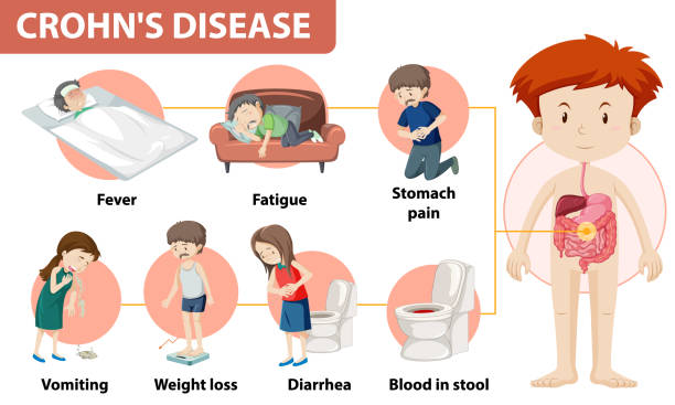 ilustraciones, imágenes clip art, dibujos animados e iconos de stock de infografía médica de la enfermedad de crohn - the vomiting of blood