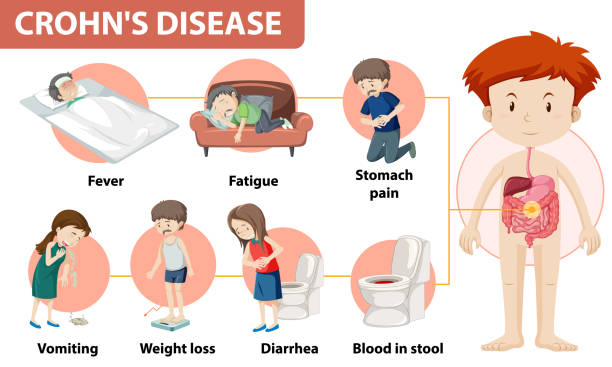 ilustrações, clipart, desenhos animados e ícones de infográfico médico da doença de crohn - the vomiting of blood