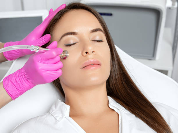 cosmetologo fa procedura microdermabrasion sul viso contro acne e punti neri vicino agli occhi. cosmetologia femminile nel salone di bellezza. - dermatology dermabrasion surgery medical foto e immagini stock