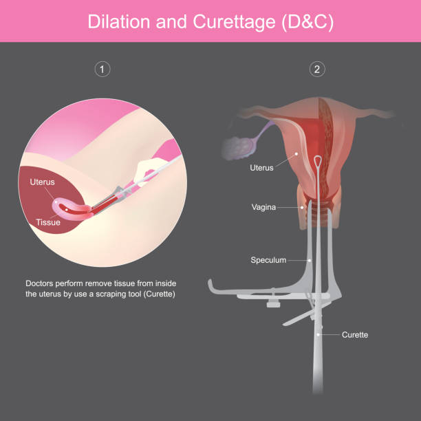 Dilation and Curettage. Doctors perform remove tissue from inside the uterus by use a scraping tool."n Dilation and Curettage. Doctors perform remove tissue from inside the uterus by use a scraping tool. fertilized egg stock illustrations