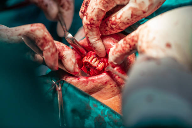 istock Jaw tumor removal by maxillofacial surgeons 1293876123