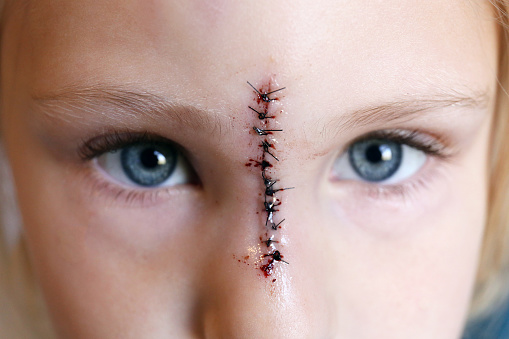 Close up on a young child's face and eyes, with stitches down the bridge of her nose from an injury.