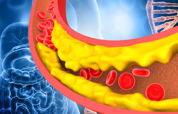 막힌 정맥 또는 막힌 동맥 - cholesterol 뉴스 사진 이미지