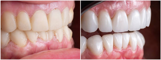 istock before and after picture after fixing 20 unit emax press ceramic veneers 1293968883