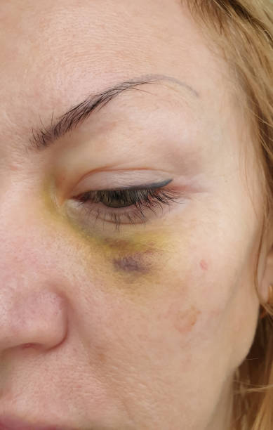 istock woman eye injury close up 1294021990
