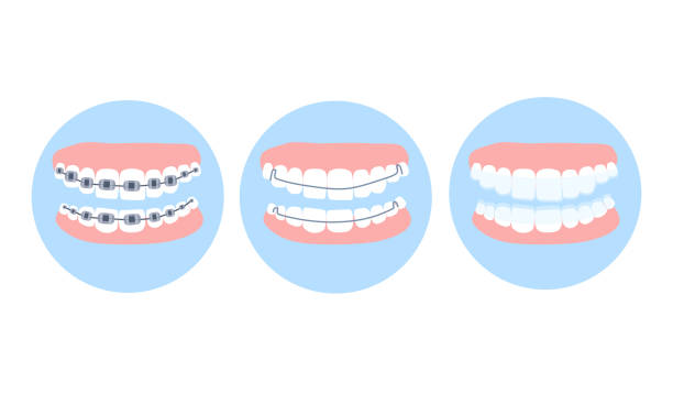 Dental metal braces,essix aligner and Hawley retainer on human teeth. Choice concept.Orthodontic surgery, oral care and hygiene.False jaw. Bruxism treatment and bite correction.Healthy smile.Vector. orthodontist stock illustrations