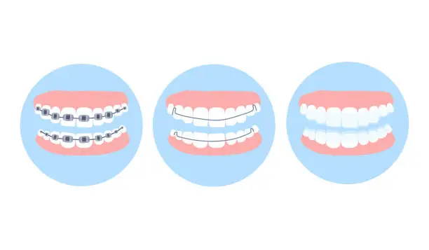 Vector illustration of Dental metal braces,essix aligner and Hawley retainer on human teeth. Choice concept.Orthodontic surgery, oral care and hygiene.False jaw.