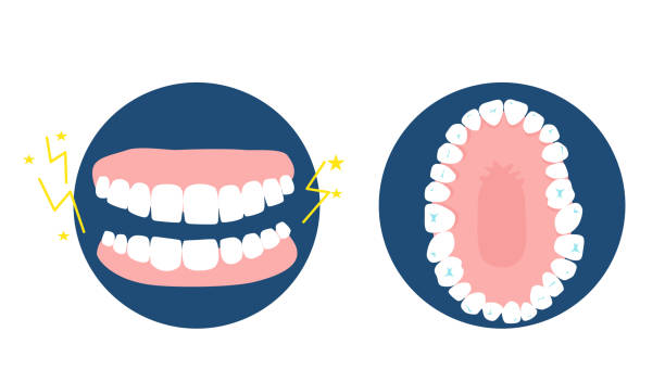 Bruxism disease concept.Human jaw top and front view.Dental and orthodontic treatment.Oral hygiene and care.Clinic advertisement poster.Dentures.Vector. CMD syndrome or temporomandibular joint disorder clenching teeth stock illustrations