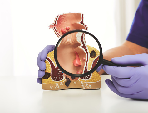 Proctólogo con una lupa en la mano que muestra patologías del recto en un modelo anatómico. Tratamiento de enfermedades rectales, hemorroides photo