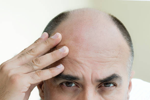 Man Is Upset By Hair Loss Stock Photo - Download Image Now - Balding, Hair  Transplant, Men - iStock