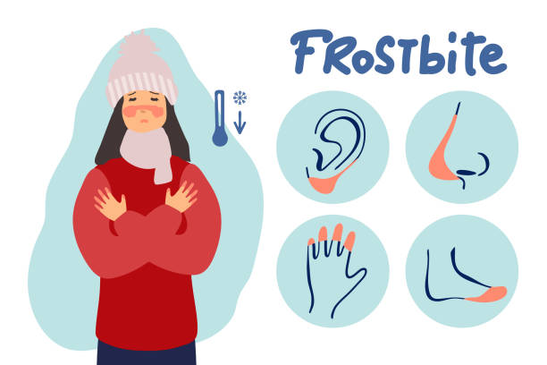 frau erfror. frostbite konzept banner. cartoon-illustration von erfrierungen vektor konzept banner. die frau ist kalt. flaches design. für infografik. - blizzard ice damaged snow stock-grafiken, -clipart, -cartoons und -symbole