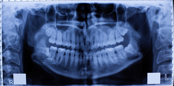 Closeup of a dental X-ray of the teeth.