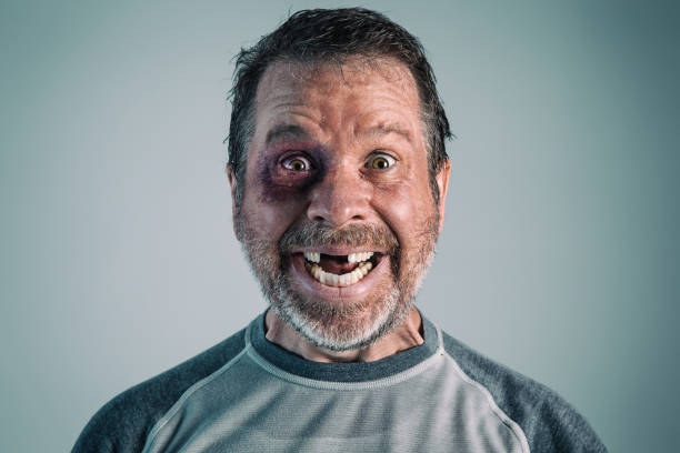 Happy Man with Black Eye and Missing Teeth Portrait of a mature adult male with a black eye and missing teeth, seemingly happy about the outcome of the fight. gap toothed photos stock pictures, royalty-free photos & images