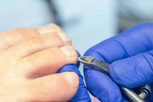 medizinische pediküre verfahren mit nagel clipper werkzeug - podiatry chiropody toenail human foot stock-fotos und bilder