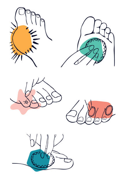 Common feet affections illustration set in graphic style,  black and white line art with colorful shapes to accentuate the problem. vector art illustration