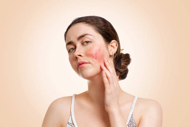 Portrait of a young pretty Caucasian woman who frowns and shows reddened and inflamed cheeks. Beige background. Copy space. The concept of rosacea, healthcare and couperose Portrait of a young pretty Caucasian woman who frowns and shows reddened and inflamed cheeks. Beige background. Copy space. The concept of rosacea, healthcare and couperose. skin inflammation stock pictures, royalty-free photos & images
