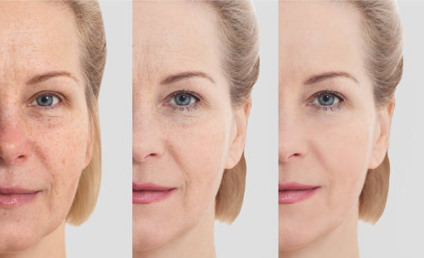 ansiktet utan smink. medelåldern näring kvinna ansikte före efter kosmetiska. hudvård för rynkiga ansikte. före-efter anti-aging ansiktslyftning behandling. ansiktshudvård och konturering. - äldre kvinna hudvård bildbanksfoton och bilder