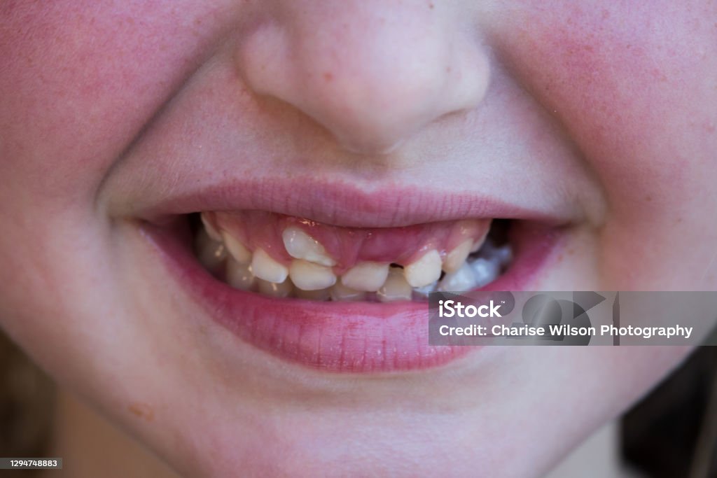 Child smiling with shark tooth on upper incisor - ectopic eruption Teeth Stock Photo