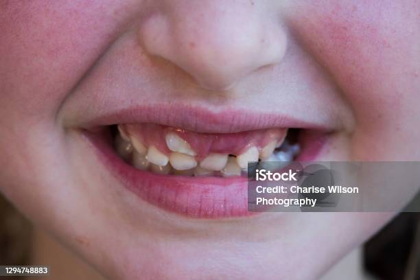 Child Smiling With Shark Tooth On Upper Incisor Ectopic Eruption Stock Photo - Download Image Now