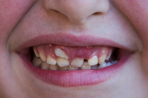 Child smiling with shark tooth on upper incisor - ectopic eruption