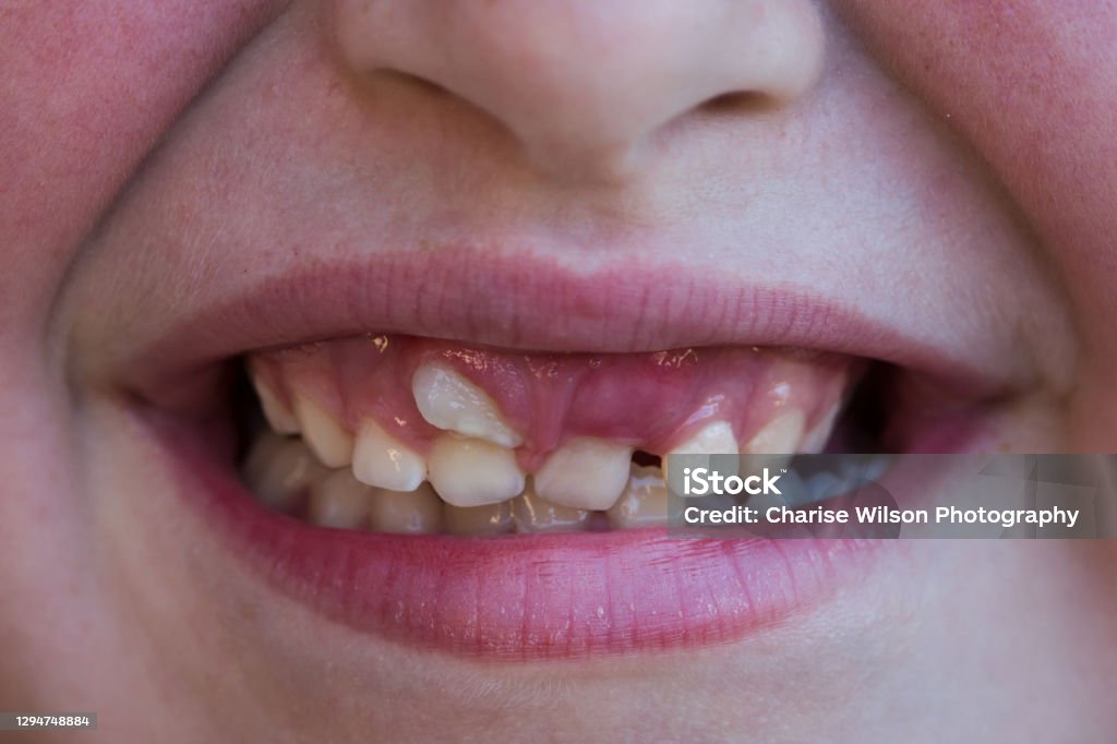 Child smiling with shark tooth on upper incisor - ectopic eruption Teeth Stock Photo