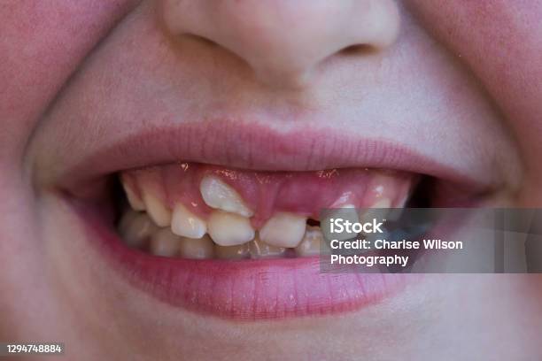 Child Smiling With Shark Tooth On Upper Incisor Ectopic Eruption Stock Photo - Download Image Now