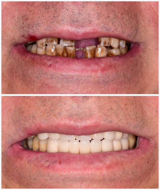 tratamiento de implante antes y después de la imagen - dental implant dental hygiene dentures prosthetic equipment fotografías e imágenes de stock