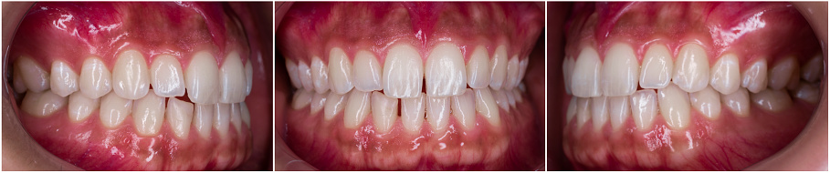 dental photography for orthodontic patient