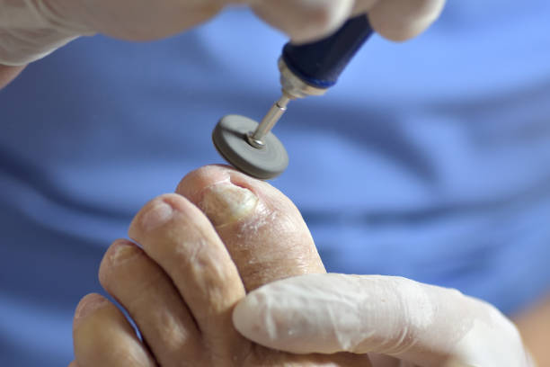 torno quiropody que suaviza la piel de los dedos - human foot podiatrist tickling podiatry fotografías e imágenes de stock
