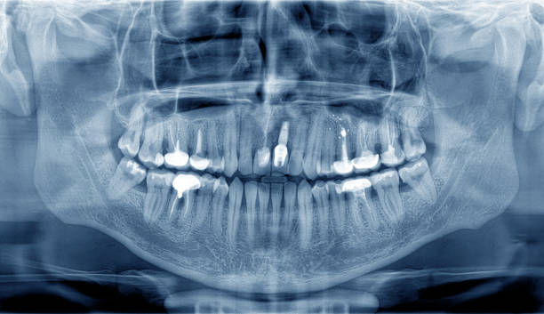 istock Blue panoramic dental X-Ray of teeth 1295519568