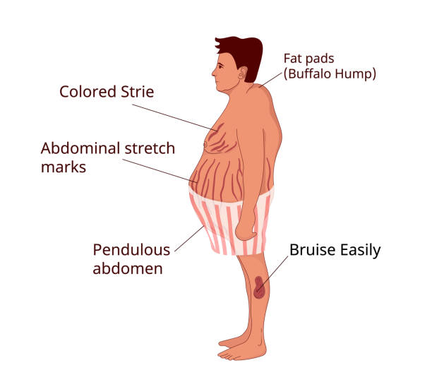 Cushing syndrome symptoms. Illustration of the common features of the cushing disease Cushing syndrome signs and symprtoms. Illustration of the obese man with cushing disease Cushing Syndrome stock illustrations
