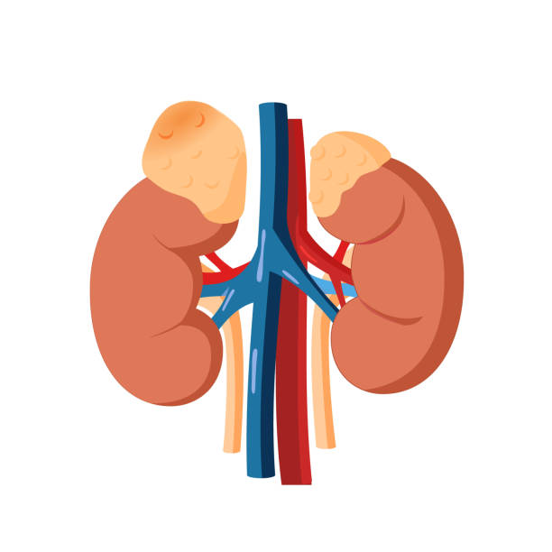 ilustrações de stock, clip art, desenhos animados e ícones de adrenal tumor vector illustration. illustration of the healthy adrenal gland and adrenal mass - suprarenal gland