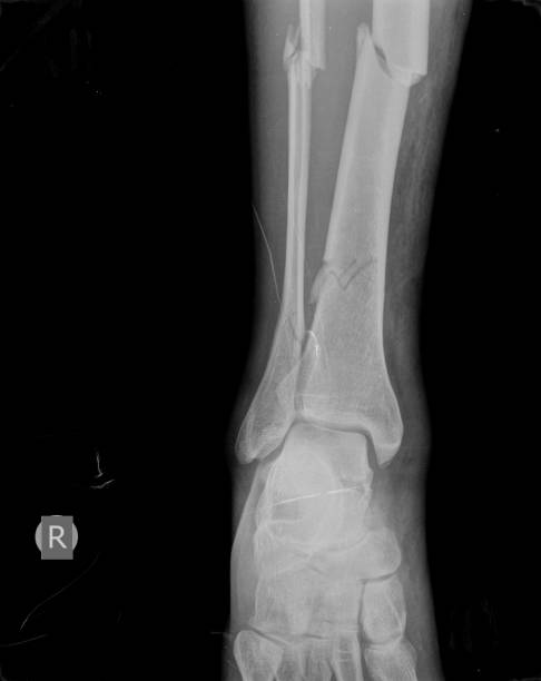 istock broken x ray image of leg 1296025750