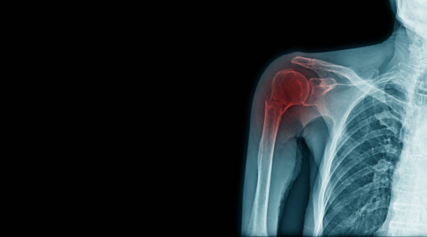 fracture aux rayons x du processus d’acromion et du cou de l’humérus - x ray x ray image shoulder human arm photos et images de collection