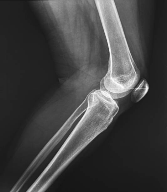 istock 42 years woman's knee with meniscus arthroscopy 1296386491