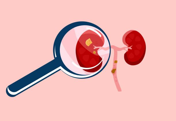 Scrutiny Kidney stone with magnifying glass.Nephrology.Pyelonephritis and renal failure disease.Inflammation in organ,cystitis chronic illness. Problem with filtration,dialysis.Vector in flat style biological process stock illustrations