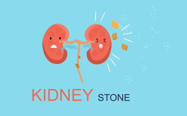 ilustrações, clipart, desenhos animados e ícones de conceito de pedra renal. o órgão humano kawaii bonito é atacado por sal de sódio. nefrologia.pyelonephrite e doença da insuficiência renal. cistite doença crônica. - kidney stone