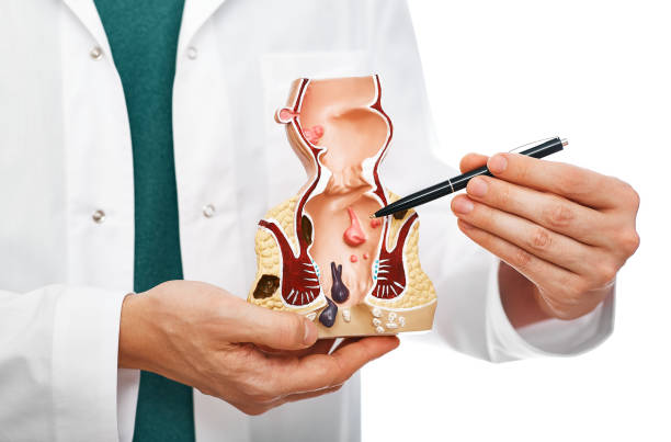 treatment of rectal diseases, hemorrhoid. proctologist pointing pen rectum pathologies on an anatomical model - hemorrhoid imagens e fotografias de stock