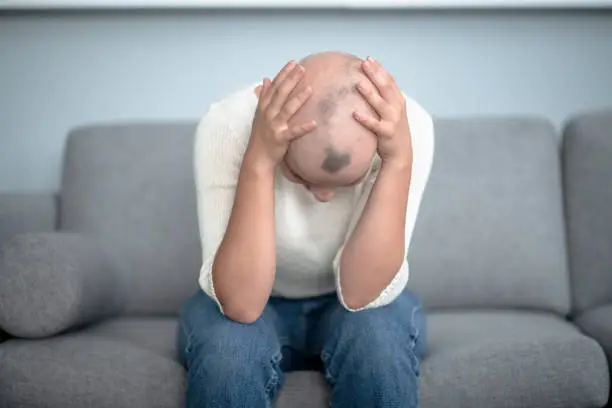 A young woman with Alopecia is looking down and has her hand on her head. She appears to be discouraged.