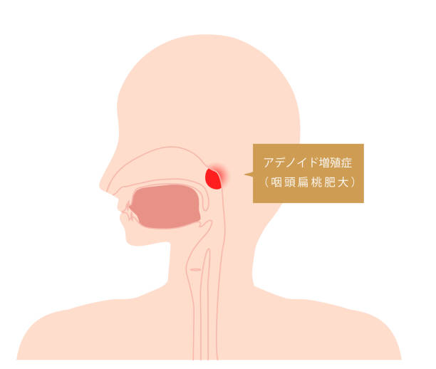 これはアデノイド肥大体の図です。 - dissection点のイラスト素材／クリップアート素材／マンガ素材／アイコン素材