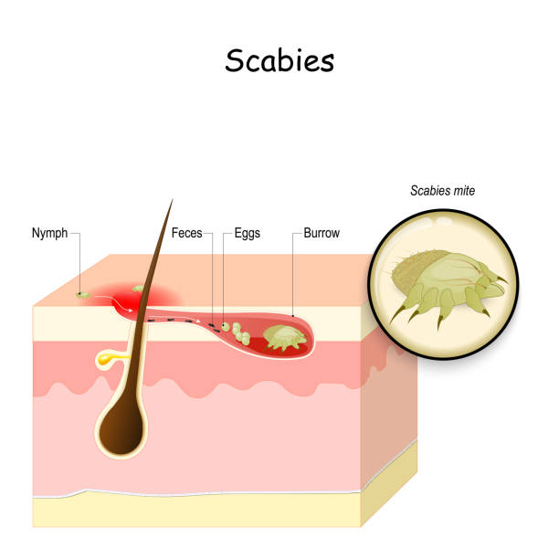 Scabies. seven-year itch Scabies. seven-year itch is a contagious skin infestation by the mite Sarcoptes scabiei. Skin with eggs and mite in a burrow. Close-up of Scabies mite. Vector illustration sarcoptes scabiei stock illustrations