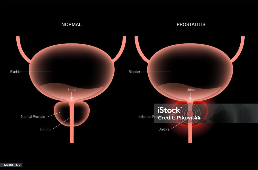 Prostatite Vetores de Problema De Inflamação Da Prostatite e mais imagens de ...