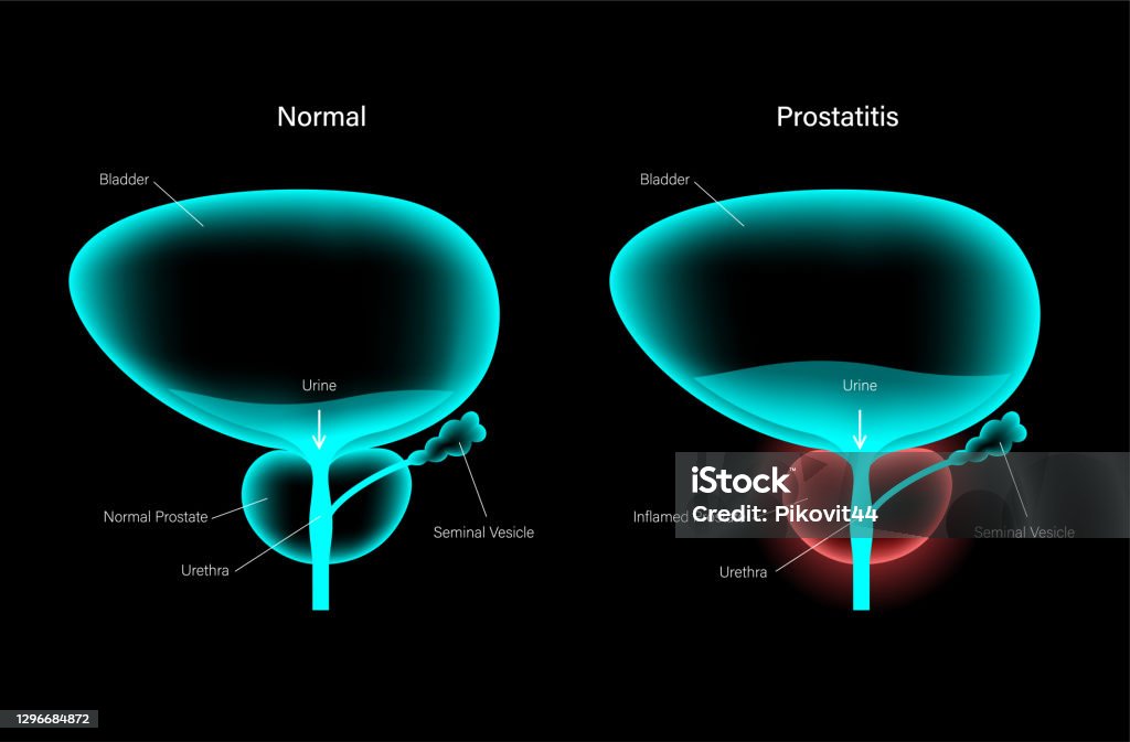 Prostatitis Inflammation Problem Stock Illustration - Download Image ...