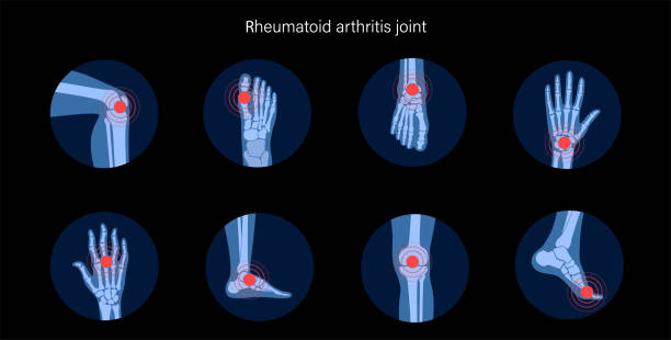 ilustraciones, imágenes clip art, dibujos animados e iconos de stock de conjuntos de artritis 2 - physical therapy human spine symbol medical exam